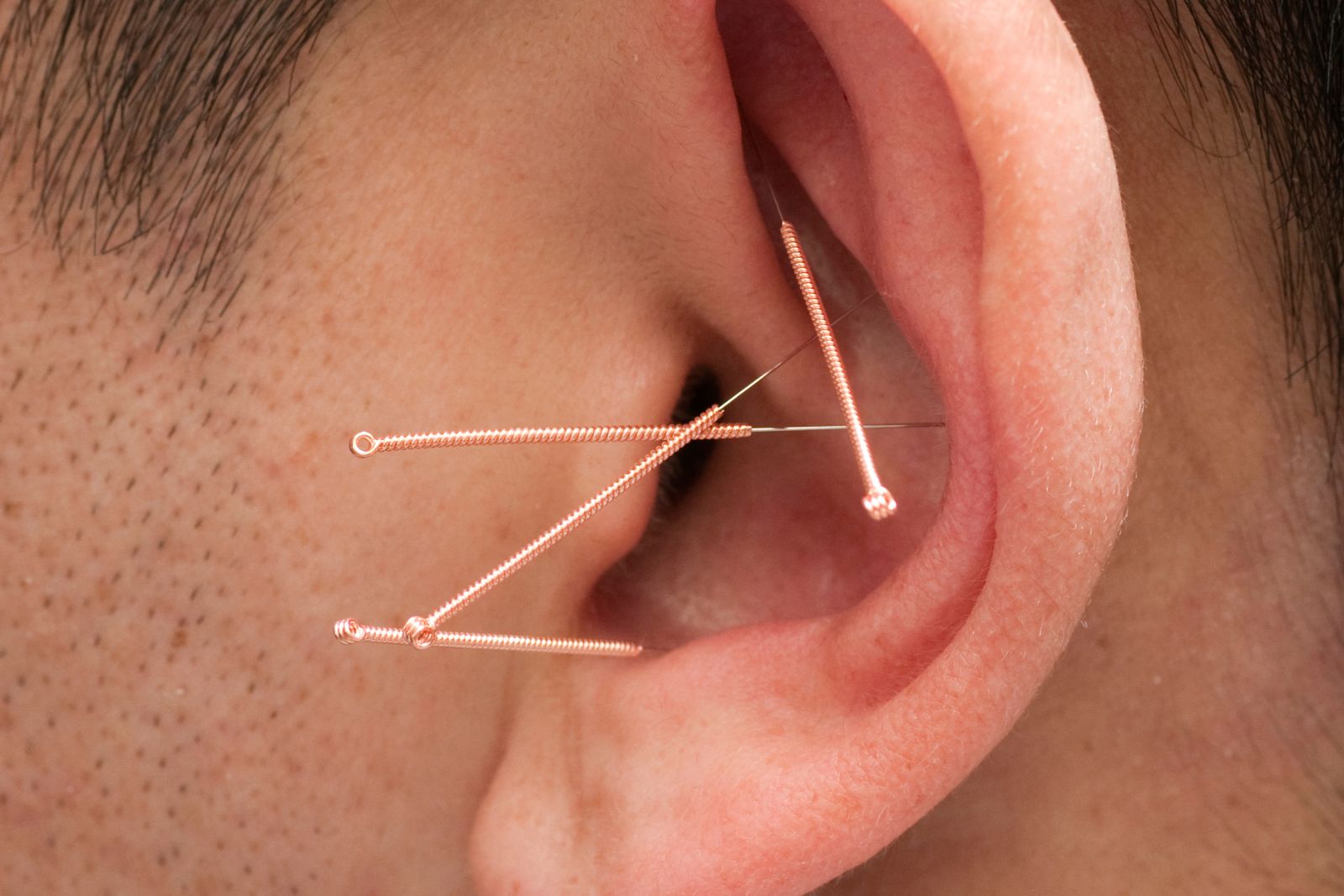 Close-up of an ear with acupuncture needles, labeled Auricular acupuncture.