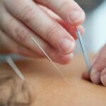 Acupuncture for depression, insert needle