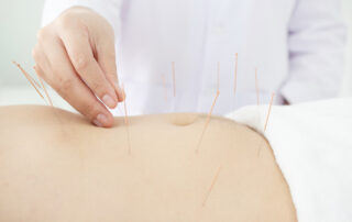 Close up of acupuncturist hands doing acupuncture at patient's belly