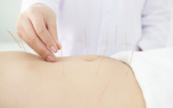 Close up of acupuncturist hands doing acupuncture at patient's belly