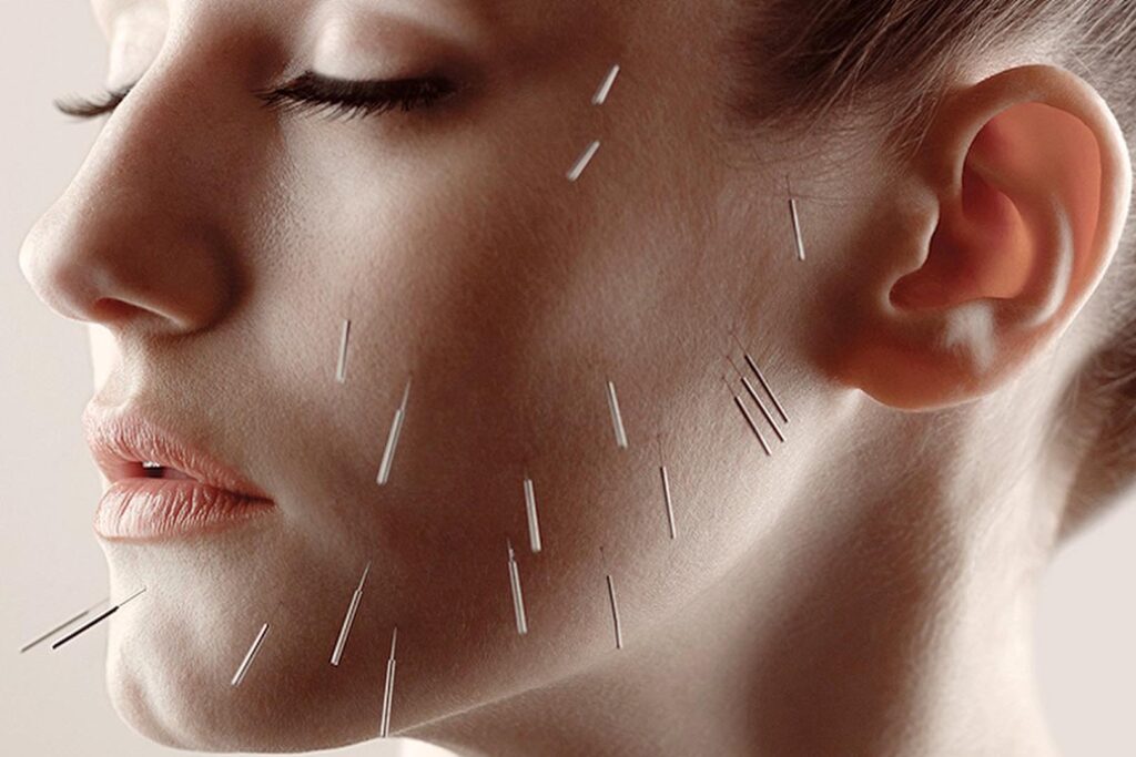 Facial Rejuvenation | Cosmetic Acupuncture Edmonton