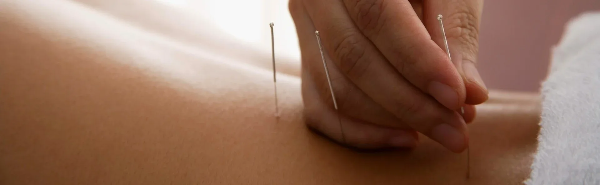 photo - classic acupuncture edmonton appointments closeup with needles being inserted into the patient's back how to know if acupuncture is working