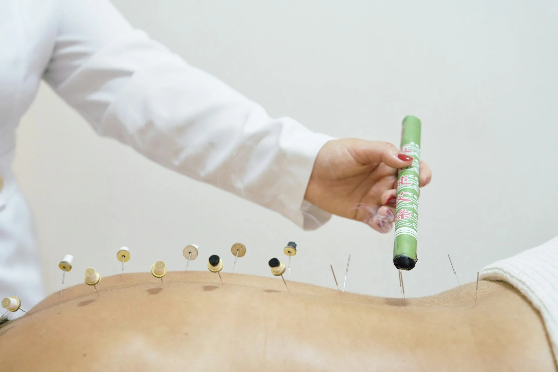 photo - an acupuncture and moxibustion treatment being performed by a specialist on a patient in a tcm edmonton clinic