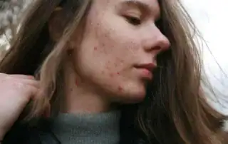 Side profile of a woman with acne on her cheek and jaw.