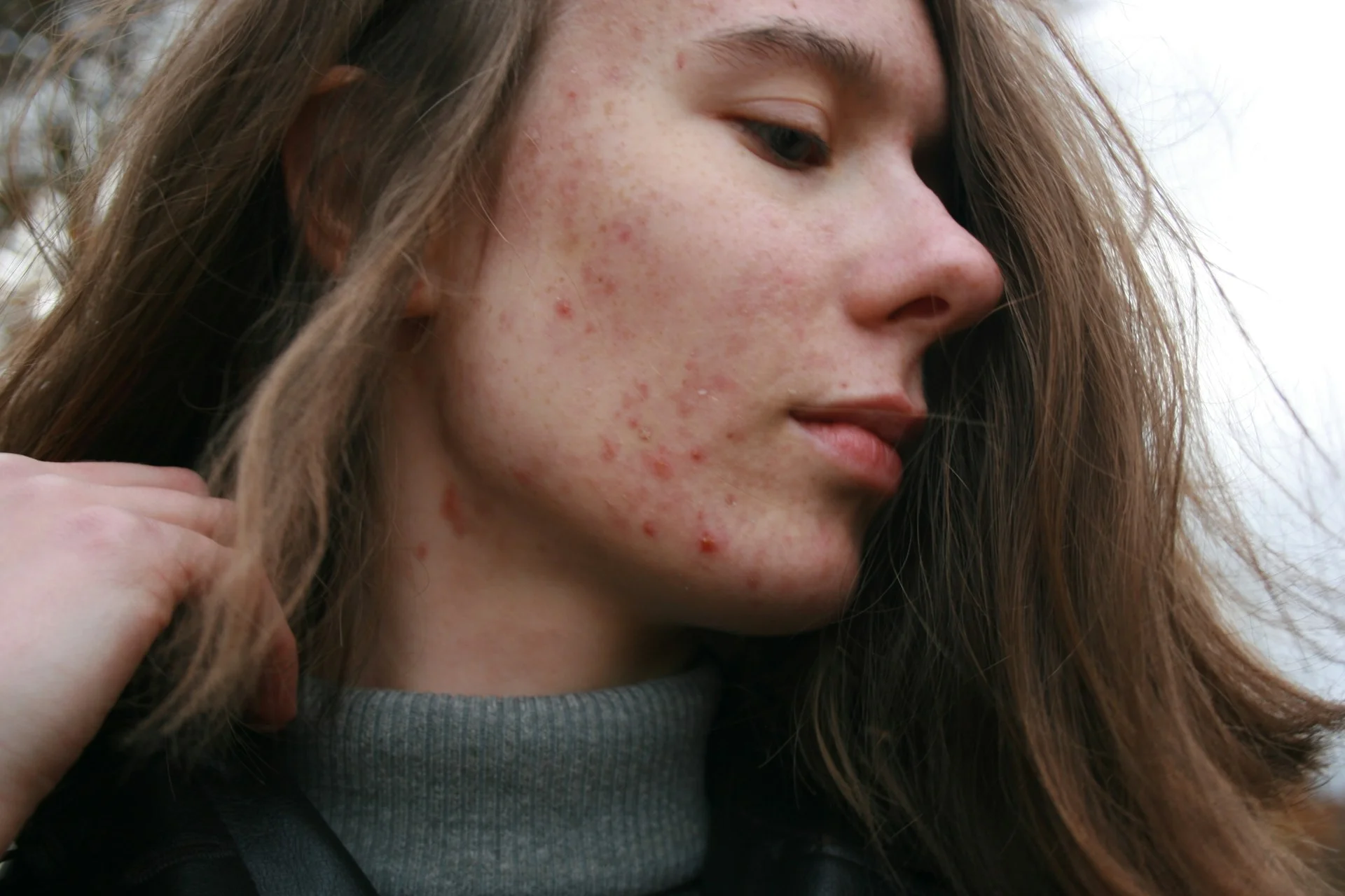 photo - a person on hormonal acne supplements looking to the side