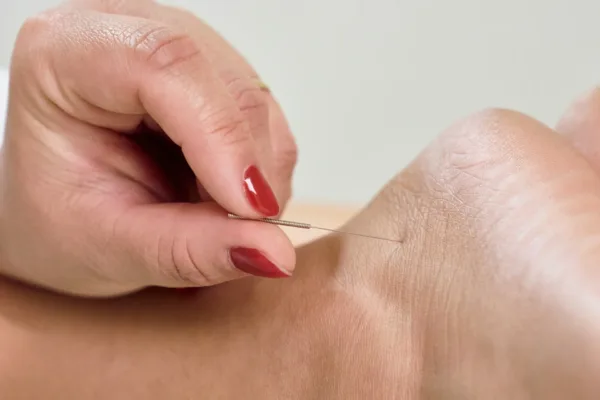 photo - how to know if acupuncture is working for healing trauma