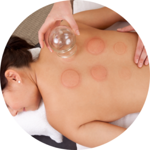 A therapist applying glass suction cups to a client's back for cupping therapy.