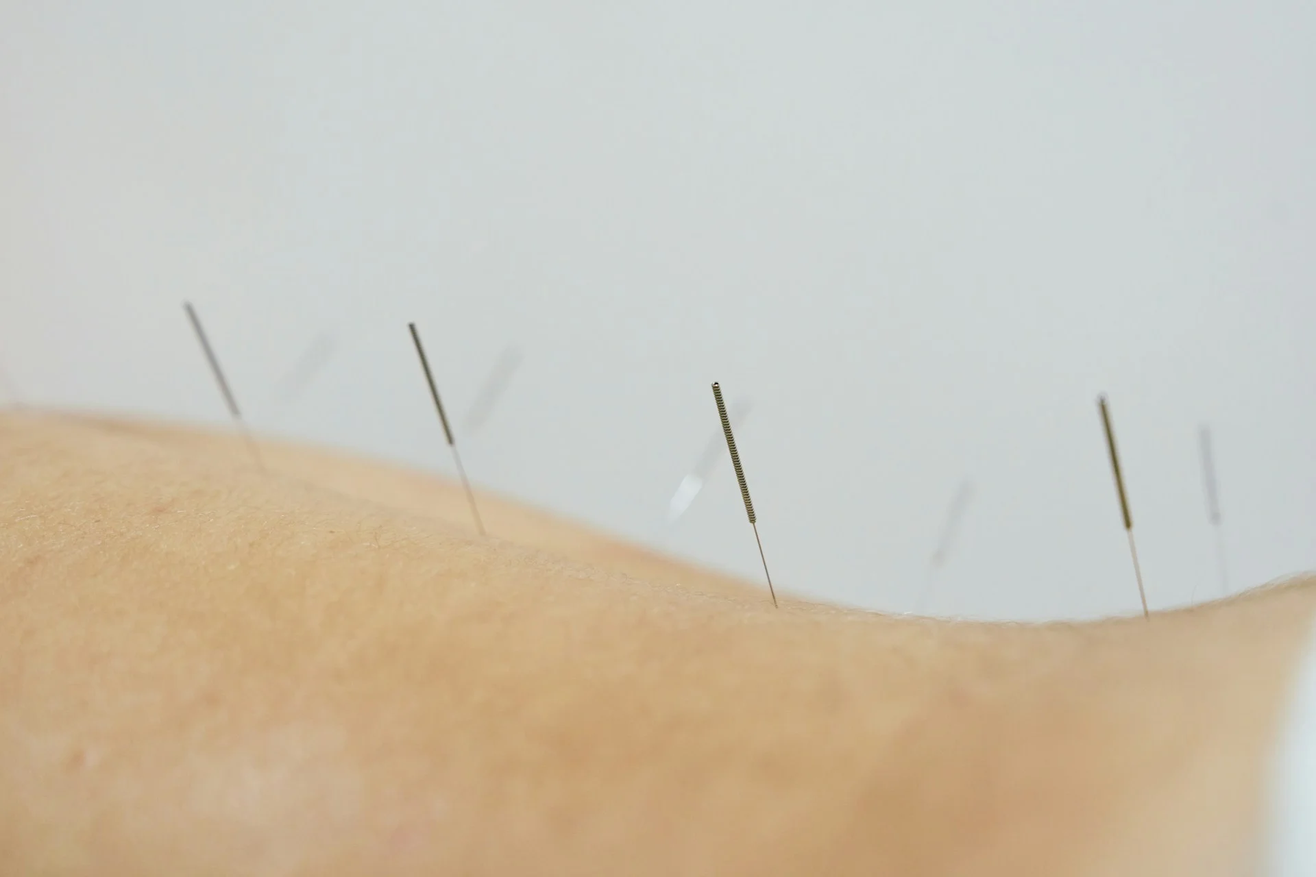 photo acupuncture needles