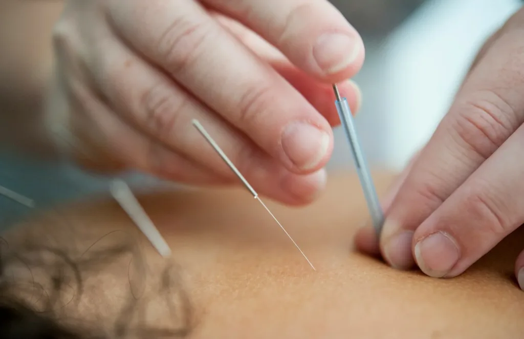 acupuncture for polycystic ovaries and endometriosis