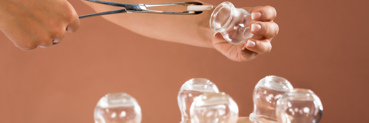 Cupping therapy being applied to a patient's back at Red Leaf Wellness Edmonton