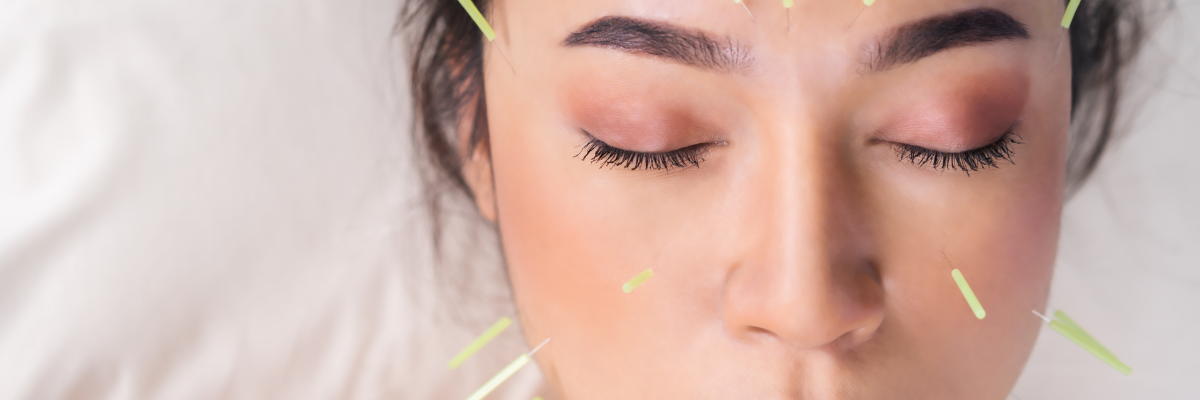 Ultra-fine acupuncture needles placed on a woman's face to stimulate collagen and improve skin tone at Red Leaf Wellness Edmonton