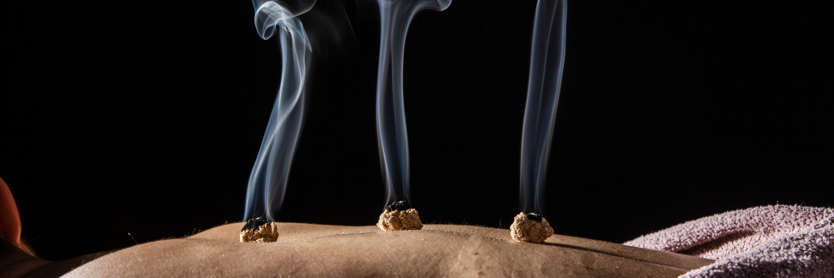 Moxibustion treatment with burning moxa producing smoke on acupuncture points at Red Leaf Wellness Edmonton