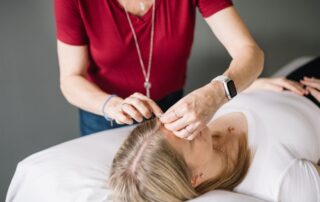 Registered Acupuncturist placing a fine acupuncture needle near a patient's hairline at Red Leaf Wellness in Edmonton.