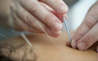 Close view of hands placing an acupuncture needle near a person’s neck.