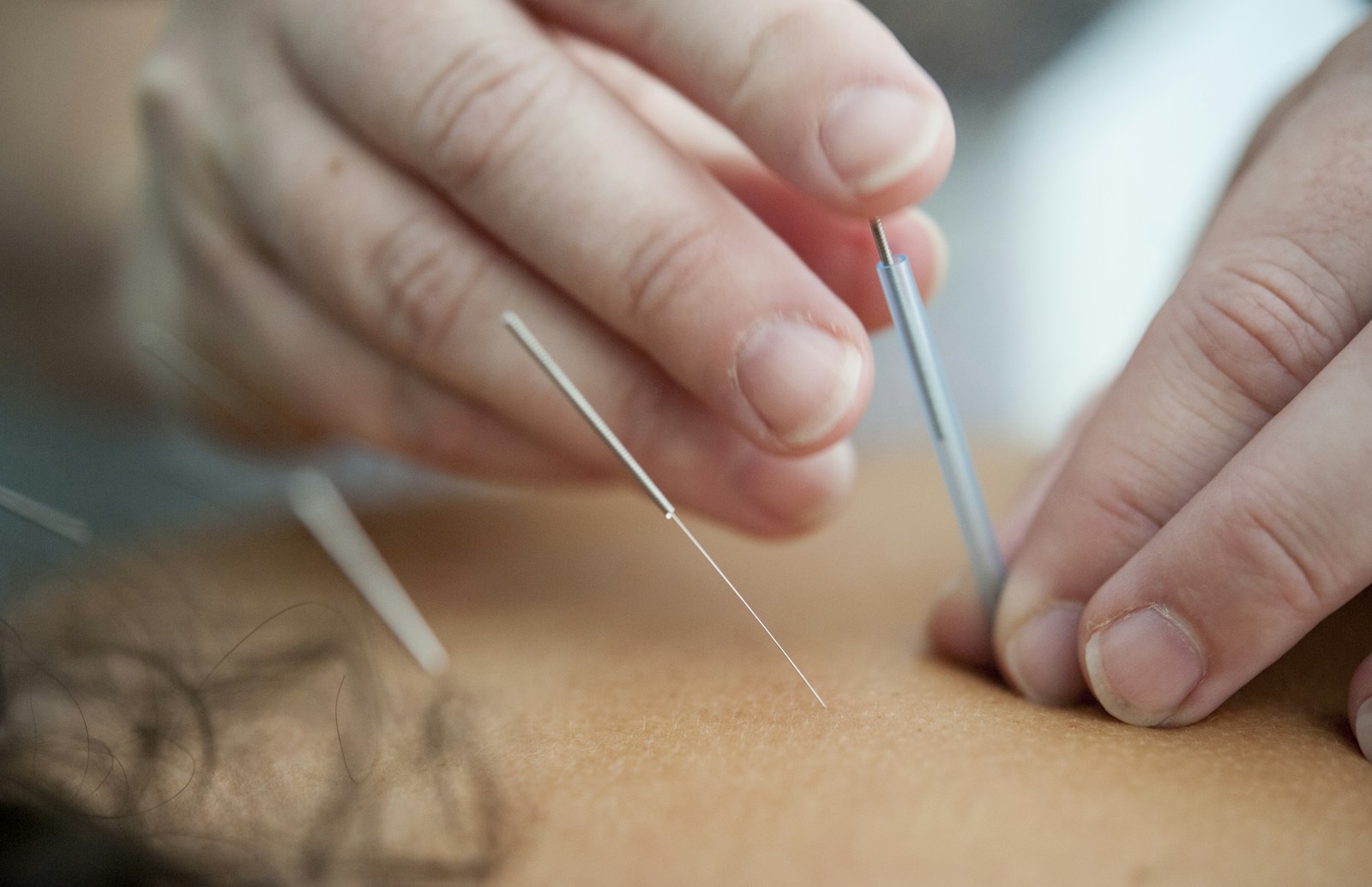 Close view of hands placing an acupuncture needle near a person’s neck.